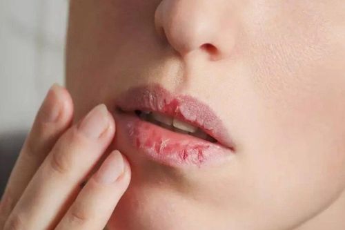 Môi khô quanh năm là thiếu chất gì?