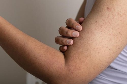 Cách đối phó với bệnh dày sừng nang lông vào mùa lạnh