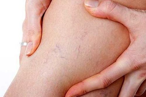 Cách ngăn ngừa giãn mao mạch