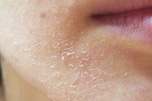 Kiểm soát tình trạng 'da rắn' trong mùa đông