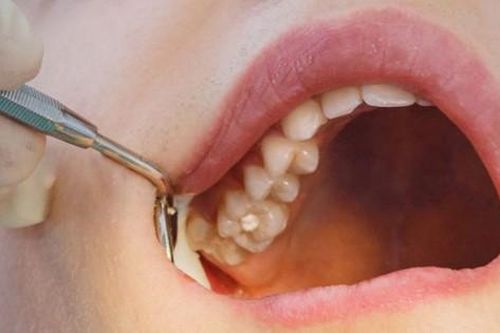 3 thứ cần biết, 6 điều cần làm sau khi nhổ răng khôn