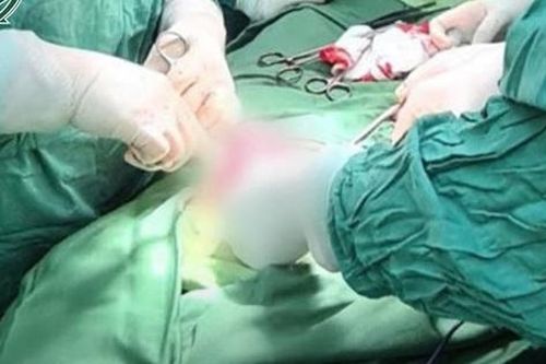 Cắt khối u xơ tử cung nằm suốt 10 năm trong người phụ nữ
