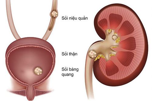 'Đẩy' sỏi thận, phải đúng cách