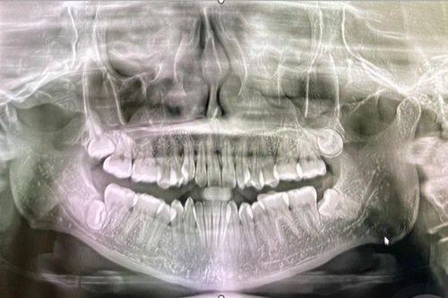 Phẫu thuật lấy 4 răng khôn mọc lệch phức tạp gây biến chứng