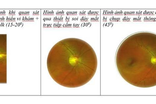 Công nghệ chụp đáy mắt giúp chẩn đoán bệnh võng mạc