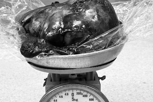Bác sĩ cân não phẫu thuật lấy khối u phổi nặng hơn 2kg chiếm hầu hết thể tích lồng ngực, cấu trúc phức tạp