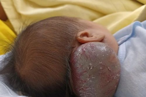 Bệnh viện Bạch Mai cứu sống trẻ có khối u máu khổng lồ hiếm gặp