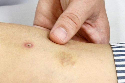 Cứu sống cụ bà nguy kịch do ong bắp cày đốt hơn 50 vết