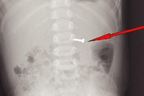 Trẻ 19 tháng tuổi nuốt ốc vít 1,5cm