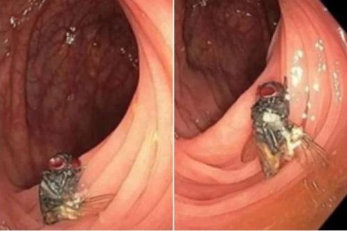 Phát hiện ruồi sống trong ruột người khi nội soi đại tràng