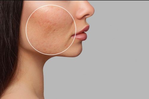 Nguyên nhân gây bít lỗ chân lông