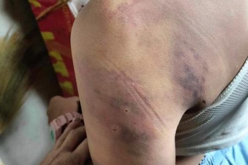 Đắk Lắk: Nữ sinh lớp 4 bị bạn cùng lớp đánh hội đồng, tâm lý bất ổn phải nhập viện