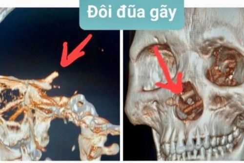 Phẫu thuật lấy đôi đũa xuyên từ mũi đến sọ não một bệnh nhân ở Quảng Bình