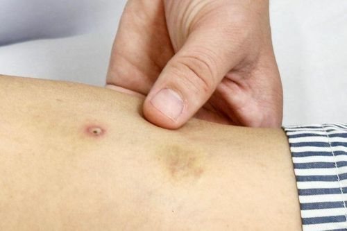 Cứu người phụ nữ bị ong đốt nguy kịch ở Bạc Liêu