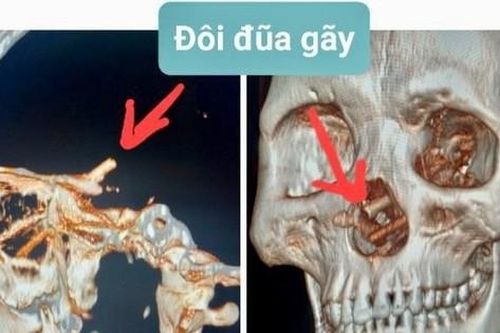 Đôi đũa nằm trong hộp sọ 5 tháng mà bệnh nhân không hề biết