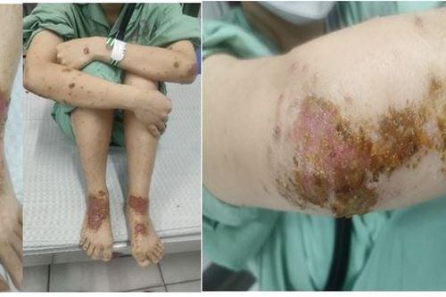 Nhiễm khuẩn, phù nề sau khi tắm thuốc nam chữa viêm da cơ địa