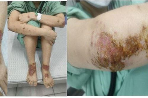 Tắm loại lá quen thuộc, bệnh nhân da thêm xù xì phải vào viện gấp