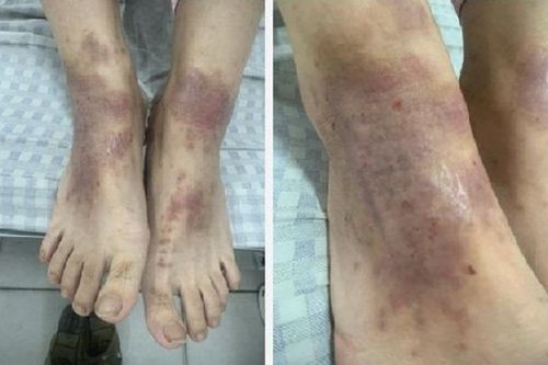 Nhiễm khuẩn, phù nề, tiết dịch vì nghe hàng xóm mách dùng thuốc nam trị viêm da cơ địa