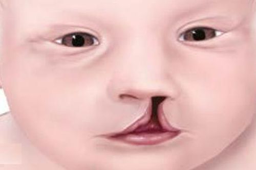 Dị tật bẩm sinh sứt môi - hở hàm ếch xảy ra ở giai đoạn nào của thai kỳ?
