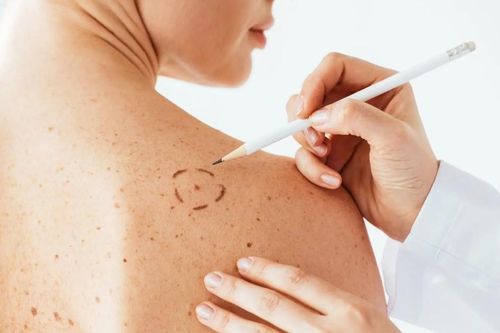 Công nghệ mới ngăn chặn sự lây lan của khối u ác tính