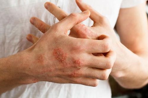 Bệnh về da hay gặp vào mùa đông và cách hạn chế