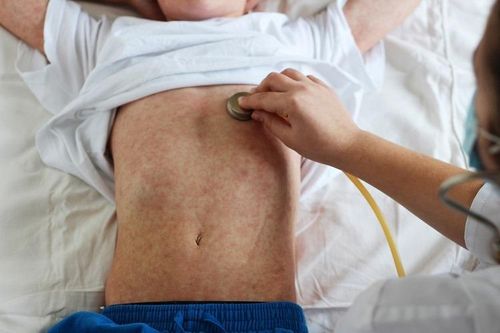 Bệnh sởi có thể bùng nổ thành vụ dịch