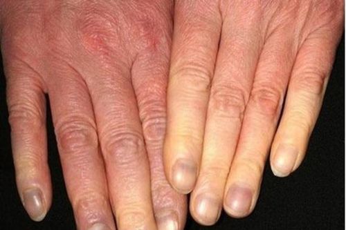 Cước tay chân mùa lạnh và cách phòng tránh