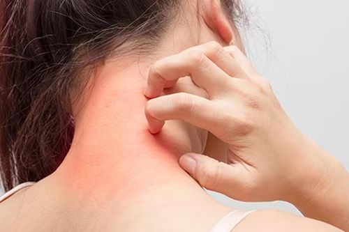 Mẹo ngăn ngừa bệnh viêm da dị ứng bùng phát trong thời tiết lạnh