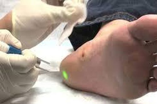 Sai lầm chí mạng khi đốt vết đen lạ ở lòng bàn chân