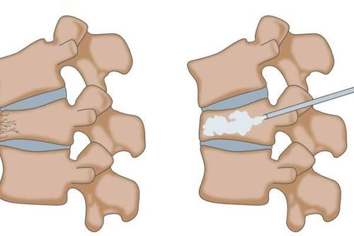 Bác sĩ trả lời: 70 tuổi bị loãng xương, bơm xi măng sinh học được không?