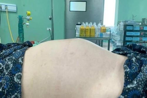Thiếu nữ 18 tuổi bụng to như mang thai 7 tháng, không ngờ u buồng trứng 'khủng'