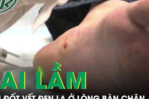 Sai lầm khi đốt vết đen lạ ở lòng bàn chân