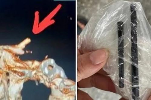 Dân mạng thế giới sốc trước vụ việc một người đàn ông bị mắc đôi đũa trong não