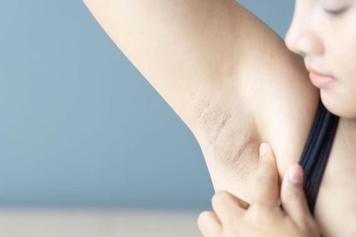 Nổi hạch ở nách có nguy hiểm không? Đây là dấu hiệu của bệnh lý gì?