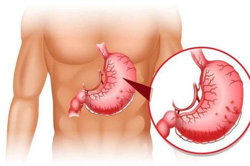 Bác sĩ trả lời: Bệnh đau dạ dày có những biểu hiện gì?