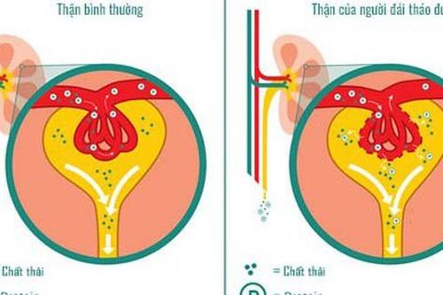 Đường máu cao ảnh hưởng thế nào đến thận?