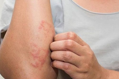 Đề phòng viêm da cơ địa khi giao mùa