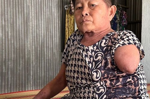 Mở rộng lòng từ: Bệnh tắc nghẽn mạch máu phải đoạn tay