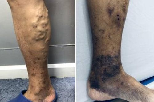 Suýt mất chân vì nhầm bệnh tuổi già