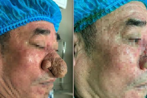 Hiếm gặp: Người đàn ông mắc bệnh mũi sư tử bịt kín đường thở