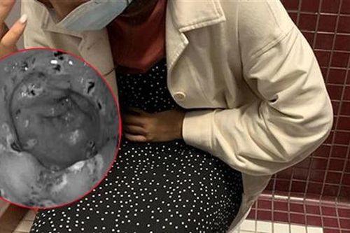 Xem nhẹ 1 bất thường khi đại tiện, lúc nội soi mới 'tá hỏa' vì có tới 30 vết loét trong dạ dày