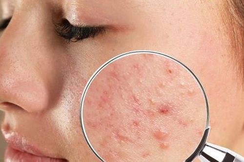 Bác sĩ tại nhà: Xử lý làn da nổi mụn 'ẩn'