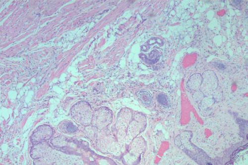 Polyp lông, bệnh hiếm gặp ở trẻ sơ sinh