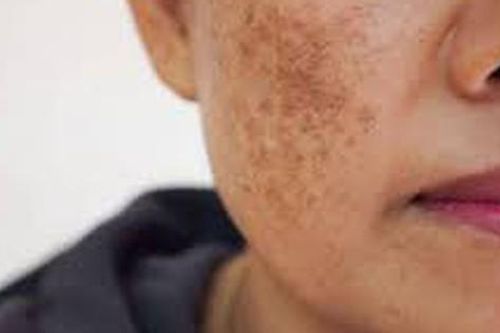 5 loại thực phẩm làm giảm sắc tố da tự nhiên