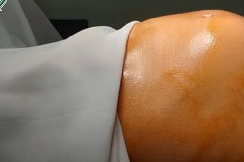 U khủng 6,2kg khiến bụng to như người mang thai 8 tháng