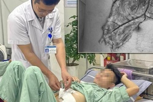 Cứu sống bệnh nhân sốc mất máu bị dao đâm thấu bụng phức tạp