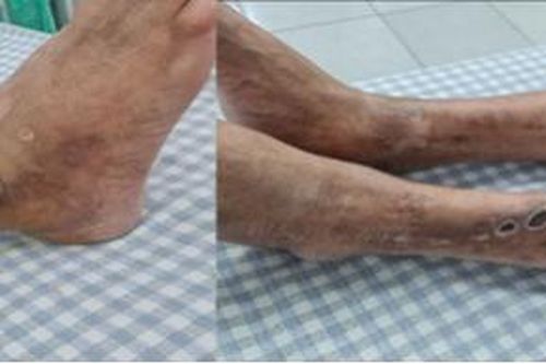 Can thiệp mạch máu, cứu người bệnh có nguy cơ bị hoại tử chân