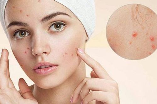 Tại sao mụn trứng cá có vẻ khỏi rồi vẫn phải điều trị duy trì?