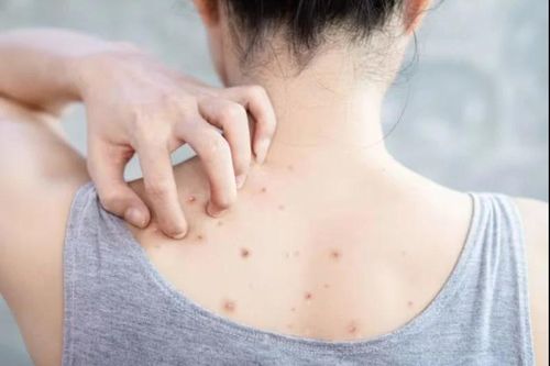 Cách giúp bạn 'đánh bật' những nốt mụn khó ưa trên lưng và cơ thể