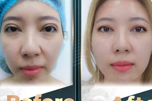 Bác sĩ phẫu thuật mí được nhiều chị em tin tưởng lựa chọn